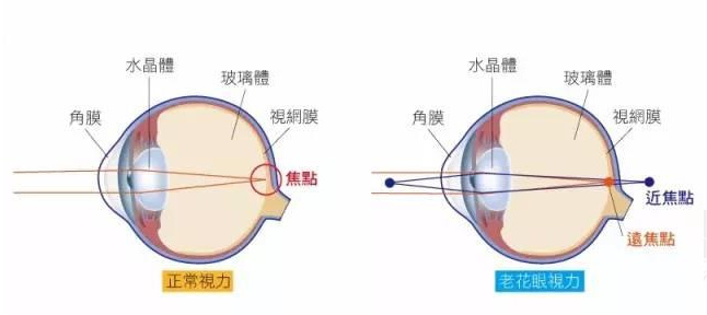 白內(nèi)障和老花眼區(qū)別，老花眼發(fā)病率正呈現(xiàn)年輕化趨勢(shì)